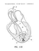 SYSTEM FOR IMPROVING CARDIAC FUNCTION BY SEALING A PARTITIONING MEMBRANE WITHIN A VENTRICLE diagram and image