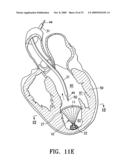 SYSTEM FOR IMPROVING CARDIAC FUNCTION BY SEALING A PARTITIONING MEMBRANE WITHIN A VENTRICLE diagram and image