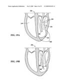 SYSTEM FOR IMPROVING CARDIAC FUNCTION BY SEALING A PARTITIONING MEMBRANE WITHIN A VENTRICLE diagram and image