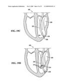 SYSTEM FOR IMPROVING CARDIAC FUNCTION BY SEALING A PARTITIONING MEMBRANE WITHIN A VENTRICLE diagram and image