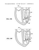 SYSTEM FOR IMPROVING CARDIAC FUNCTION BY SEALING A PARTITIONING MEMBRANE WITHIN A VENTRICLE diagram and image