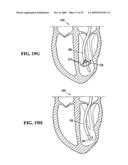 SYSTEM FOR IMPROVING CARDIAC FUNCTION BY SEALING A PARTITIONING MEMBRANE WITHIN A VENTRICLE diagram and image