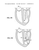 SYSTEM FOR IMPROVING CARDIAC FUNCTION BY SEALING A PARTITIONING MEMBRANE WITHIN A VENTRICLE diagram and image