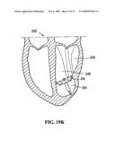 SYSTEM FOR IMPROVING CARDIAC FUNCTION BY SEALING A PARTITIONING MEMBRANE WITHIN A VENTRICLE diagram and image