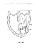 SYSTEM FOR IMPROVING CARDIAC FUNCTION BY SEALING A PARTITIONING MEMBRANE WITHIN A VENTRICLE diagram and image