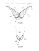 SYSTEM FOR IMPROVING CARDIAC FUNCTION BY SEALING A PARTITIONING MEMBRANE WITHIN A VENTRICLE diagram and image