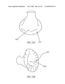 SYSTEM FOR IMPROVING CARDIAC FUNCTION BY SEALING A PARTITIONING MEMBRANE WITHIN A VENTRICLE diagram and image