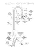 SYSTEM FOR IMPROVING CARDIAC FUNCTION BY SEALING A PARTITIONING MEMBRANE WITHIN A VENTRICLE diagram and image