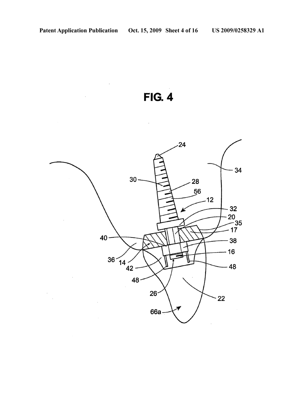 DENTAL IMPLANT - diagram, schematic, and image 05