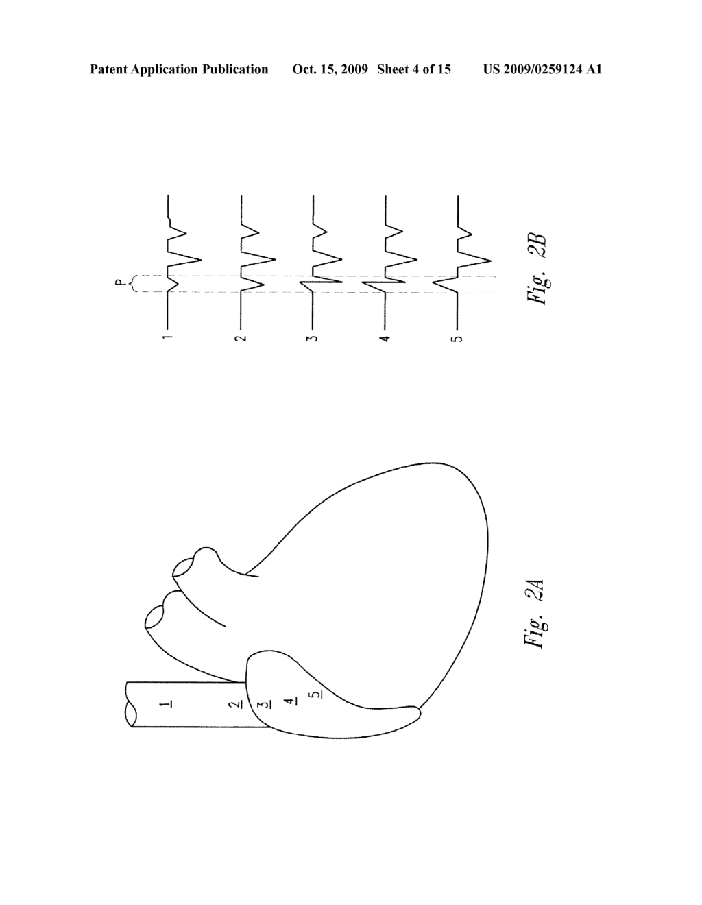 METHOD OF LOCATING THE TIP OF A CENTRAL VENOUS CATHETER - diagram, schematic, and image 05