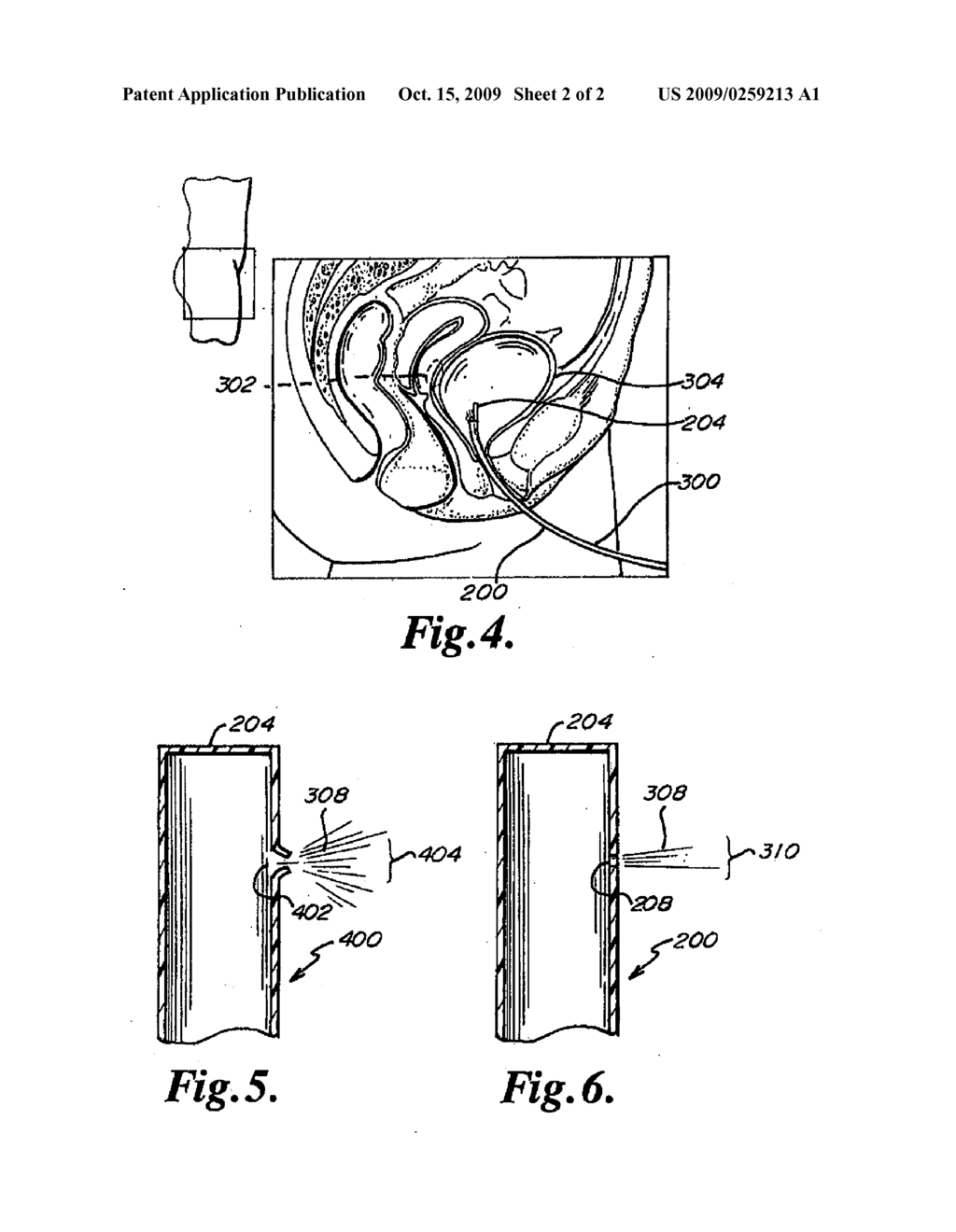 INJECTION TUBE FOR JET INJECTION DEVICE - diagram, schematic, and image 03
