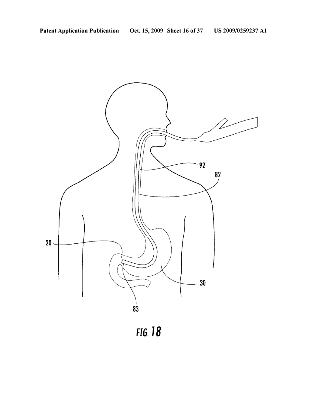 Pyloric valve devices and methods - diagram, schematic, and image 17