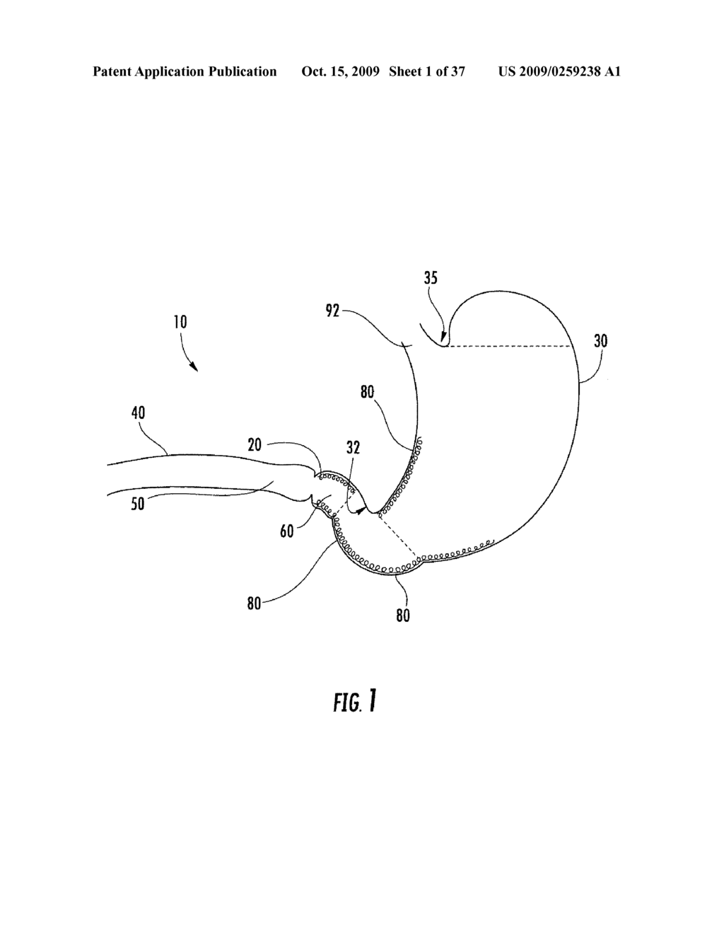 Pyloric valve devices and methods - diagram, schematic, and image 02