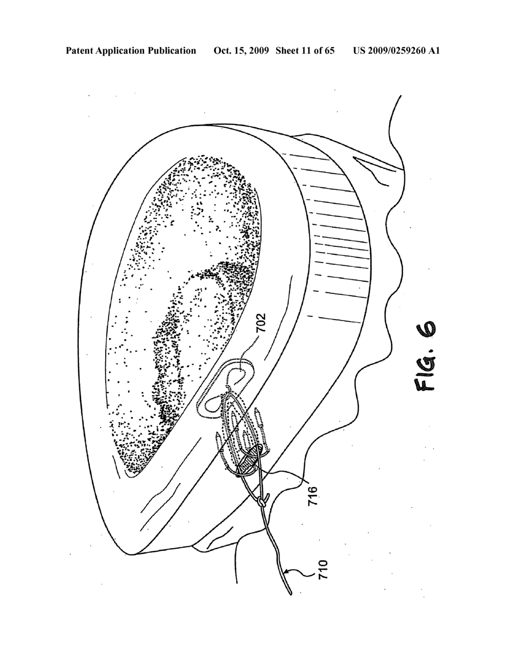 METHOD AND APPARATUS FOR THE TREATMENT OF THE INTERVERTEBRAL DISC ANNULUS - diagram, schematic, and image 12