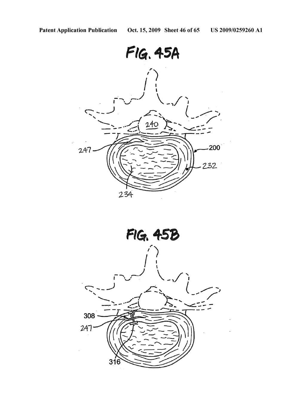 METHOD AND APPARATUS FOR THE TREATMENT OF THE INTERVERTEBRAL DISC ANNULUS - diagram, schematic, and image 47