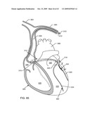 ELECTRONIC NETWORK COMPONENTS UTILIZING BIOCOMPATIBLE CONDUCTIVE ADHESIVES FOR DIRECT BODY FLUID EXPOSURE diagram and image