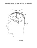 ELECTRONIC NETWORK COMPONENTS UTILIZING BIOCOMPATIBLE CONDUCTIVE ADHESIVES FOR DIRECT BODY FLUID EXPOSURE diagram and image