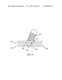 Side Branch Stent Having a Proximal Split Ring diagram and image