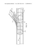 Side Branch Stent Having a Proximal Split Ring diagram and image