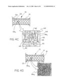 REMOVABLE STENT-GRAFT diagram and image