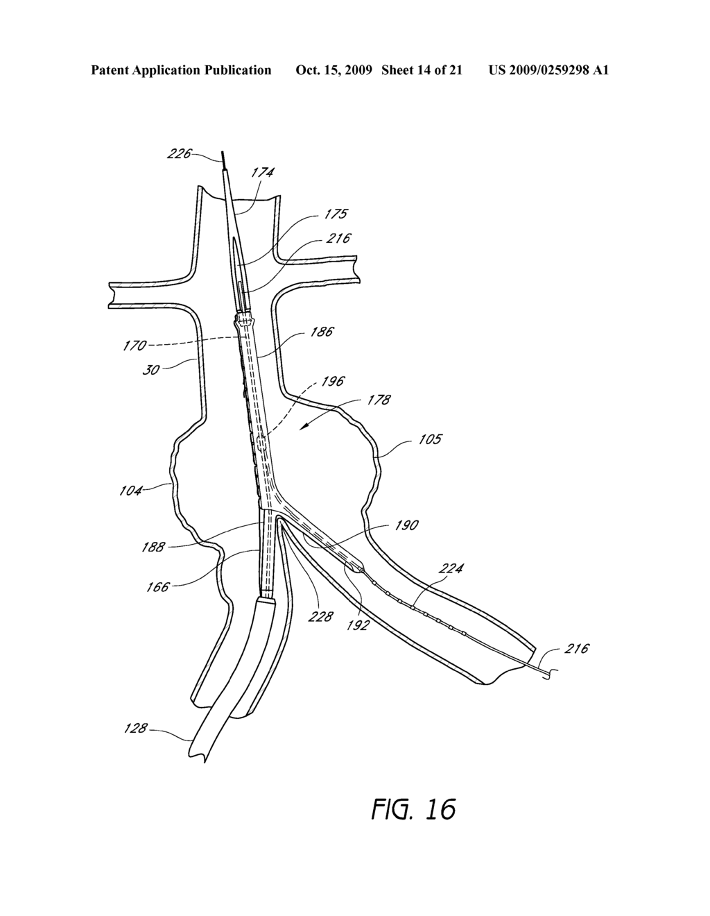 BIFURCATED GRAFT DEPLOYMENT SYSTEMS AND METHODS - diagram, schematic, and image 15