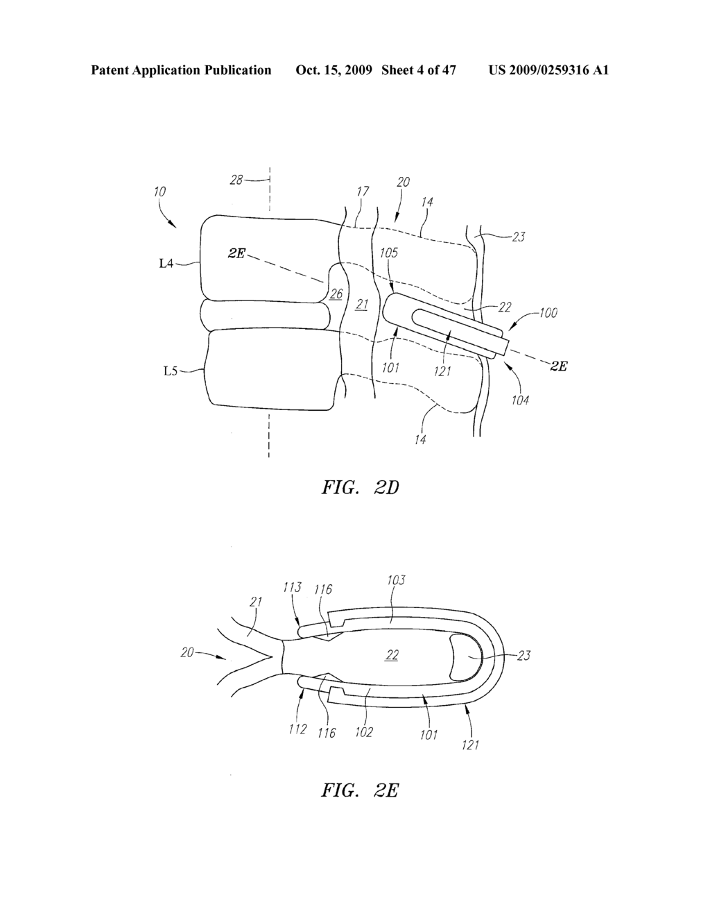 Spacer Devices and Systems for the Treatment of Spinal Stenosis and Methods for Using the Same - diagram, schematic, and image 05