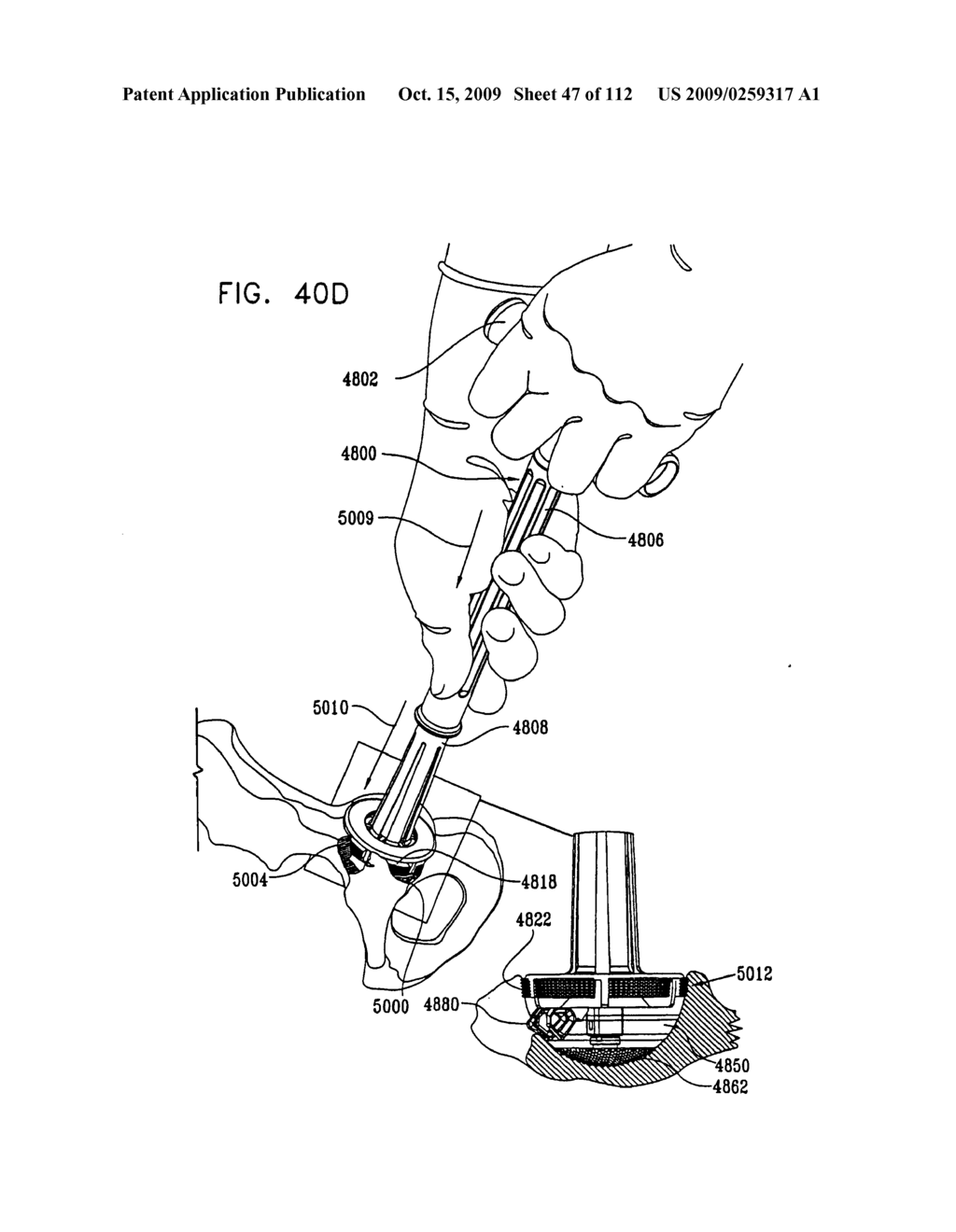 Cushion Bearing Implants for Load Bearing Applications - diagram, schematic, and image 48