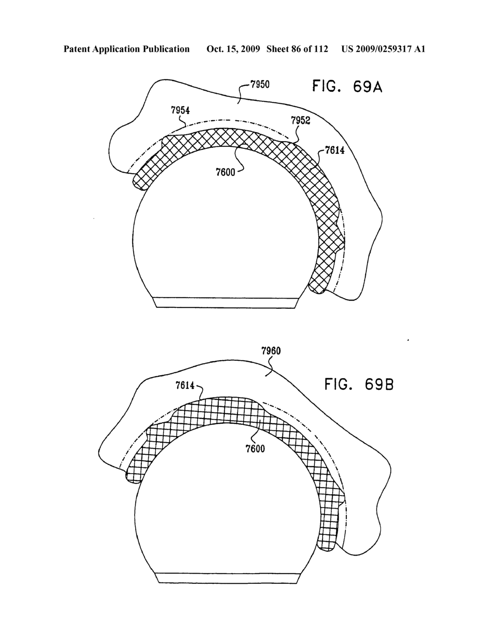 Cushion Bearing Implants for Load Bearing Applications - diagram, schematic, and image 87