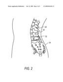 Methods and Compositions for Reducing Preventing and Treating Adhesives diagram and image