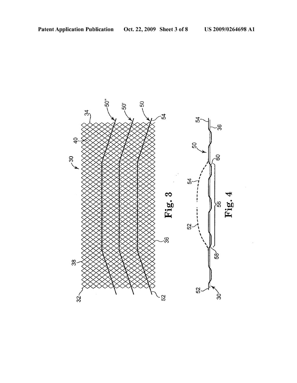 METHODS AND APPARATUS FOR SECURING AND TENSIONING A URETHRAL SLING TO PUBIC BONE - diagram, schematic, and image 04