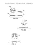 METHODS OF IMPLANTING AN INJECTION PORT diagram and image