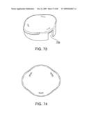 METHODS OF IMPLANTING AN INJECTION PORT diagram and image