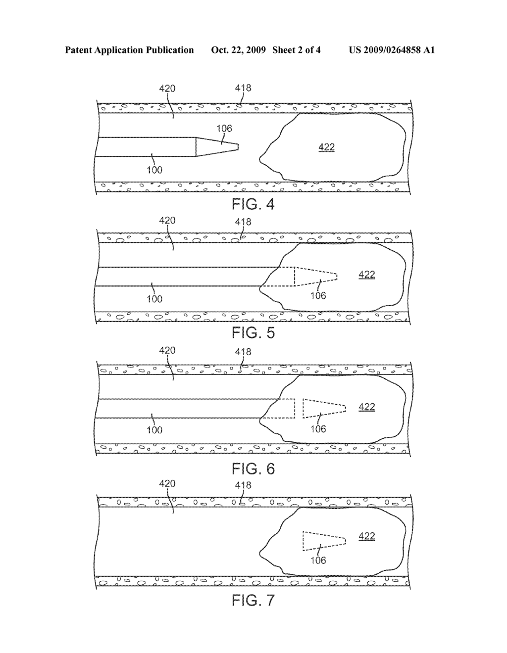 Catheter Having a Detachable Tip - diagram, schematic, and image 03