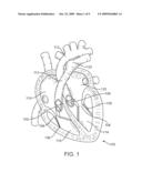 Articulating Tip Tetherless Catheter System diagram and image