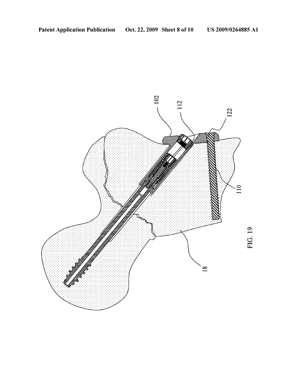 Orthopaedic trauma hip screw assembly - diagram, schematic, and image 09