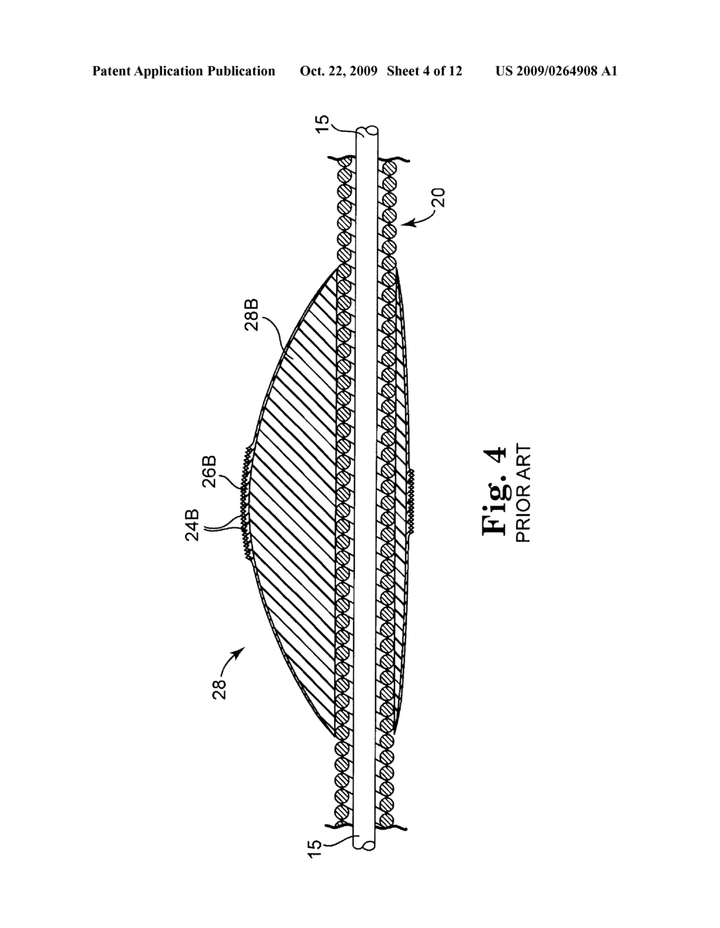 METHOD AND APPARATUS FOR INCREASING ROTATIONAL AMPLITUDE OF ABRASIVE ELEMENT ON HIGH-SPEED ROTATIONAL ATHERECTOMY DEVICE - diagram, schematic, and image 05