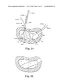 INSTRUMENT SET AND METHOD FOR PERFORMING SPINAL NUCLECTOMY diagram and image