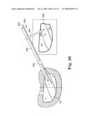 INSTRUMENT SET AND METHOD FOR PERFORMING SPINAL NUCLECTOMY diagram and image