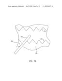 Family of Electrodes for Use in Performing in Situ Fenestration Using a Plasma RF Catheter diagram and image