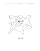 Family of Electrodes for Use in Performing in Situ Fenestration Using a Plasma RF Catheter diagram and image