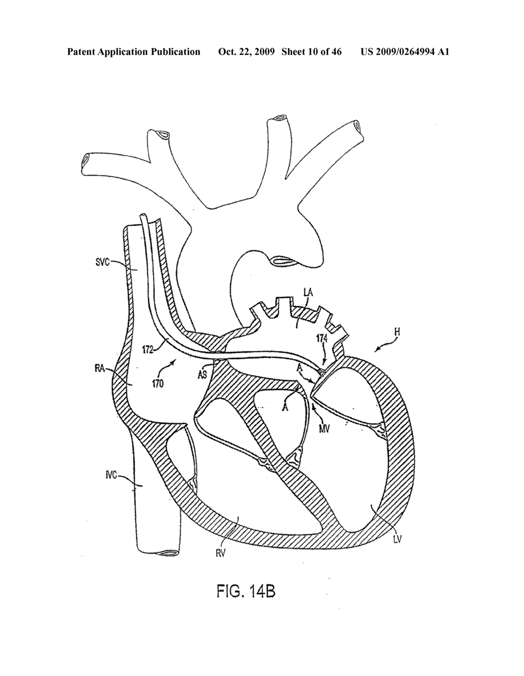 APPARATUS AND METHODS FOR TREATING TISSUE - diagram, schematic, and image 11