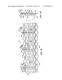 Everting Heart Valve diagram and image