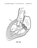 Everting Heart Valve diagram and image