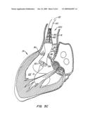 Everting Heart Valve diagram and image