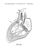 Everting Heart Valve diagram and image