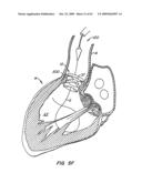 Everting Heart Valve diagram and image