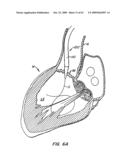 Everting Heart Valve diagram and image