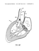Everting Heart Valve diagram and image
