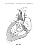 Everting Heart Valve diagram and image