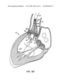 Everting Heart Valve diagram and image